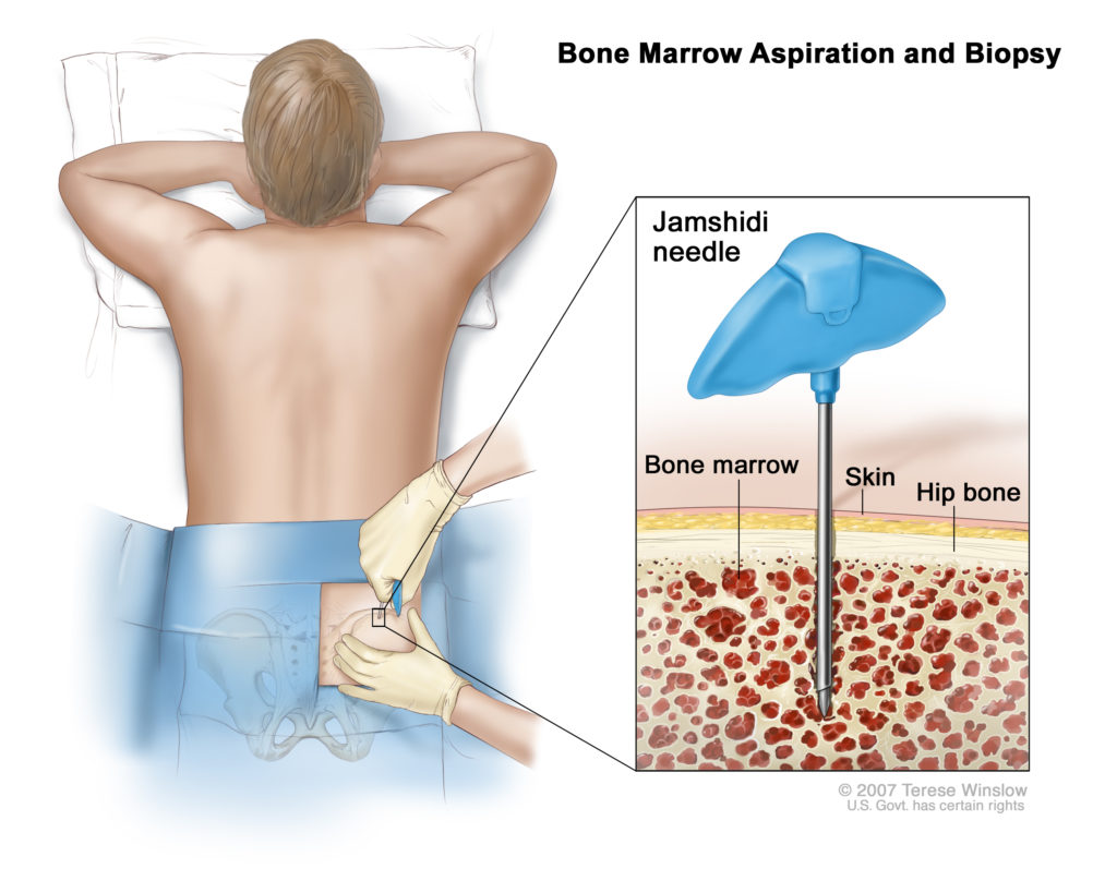 Bone Marrow Aspiration and Biopsy