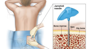 Bone Marrow Aspiration and Biopsy