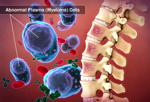 myelom beslenme